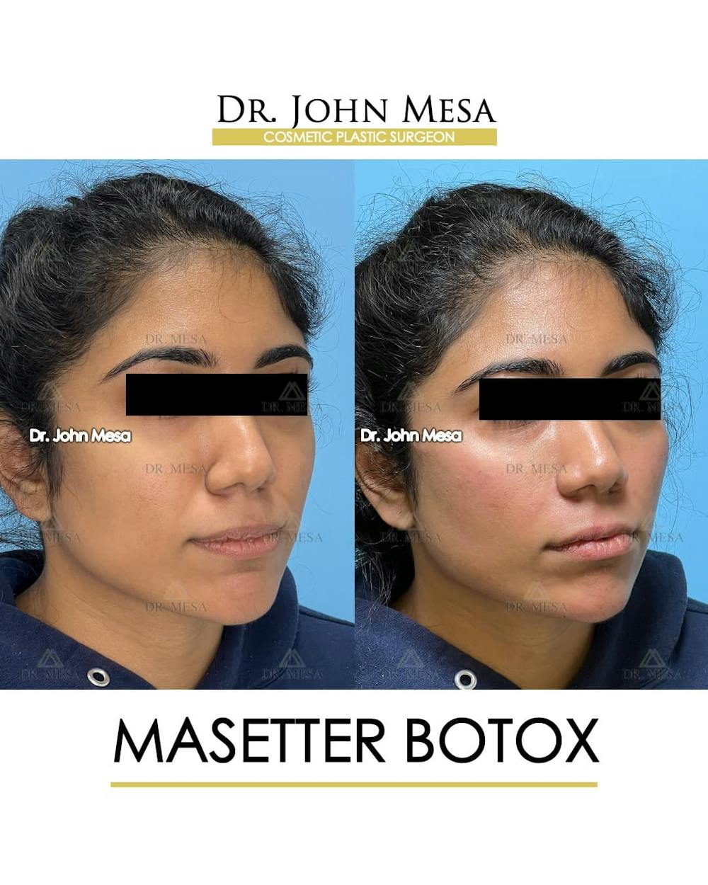 BOTOX Before & After Gallery - Patient 185252 - Image 3