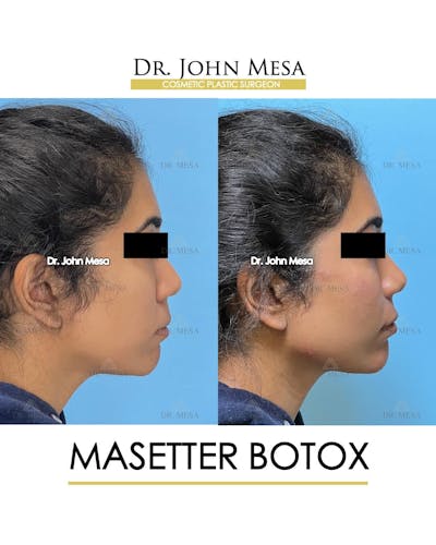 BOTOX Before & After Gallery - Patient 185252 - Image 4