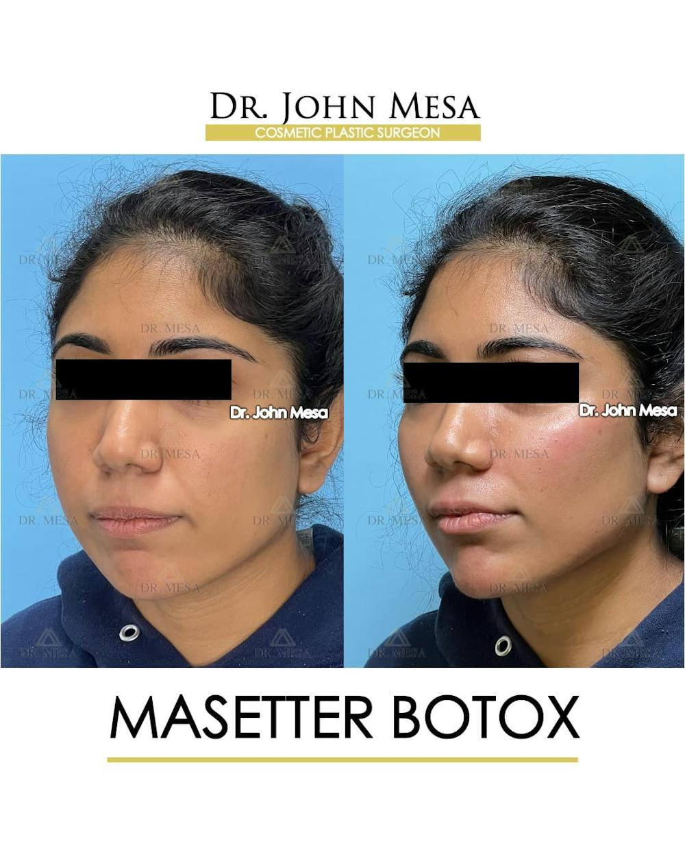 BOTOX Before & After Gallery - Patient 185252 - Image 5