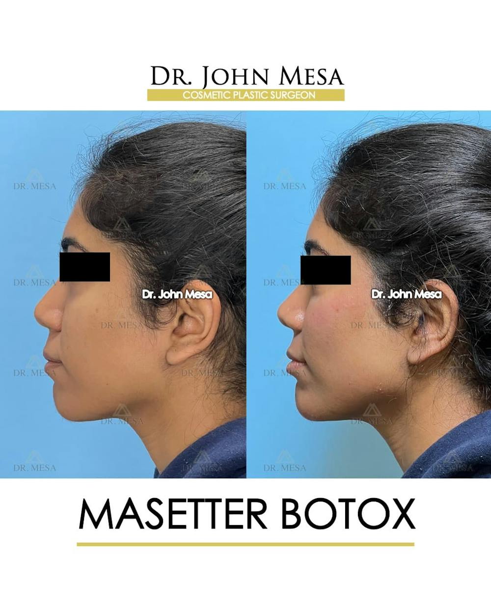 BOTOX Before & After Gallery - Patient 185252 - Image 6