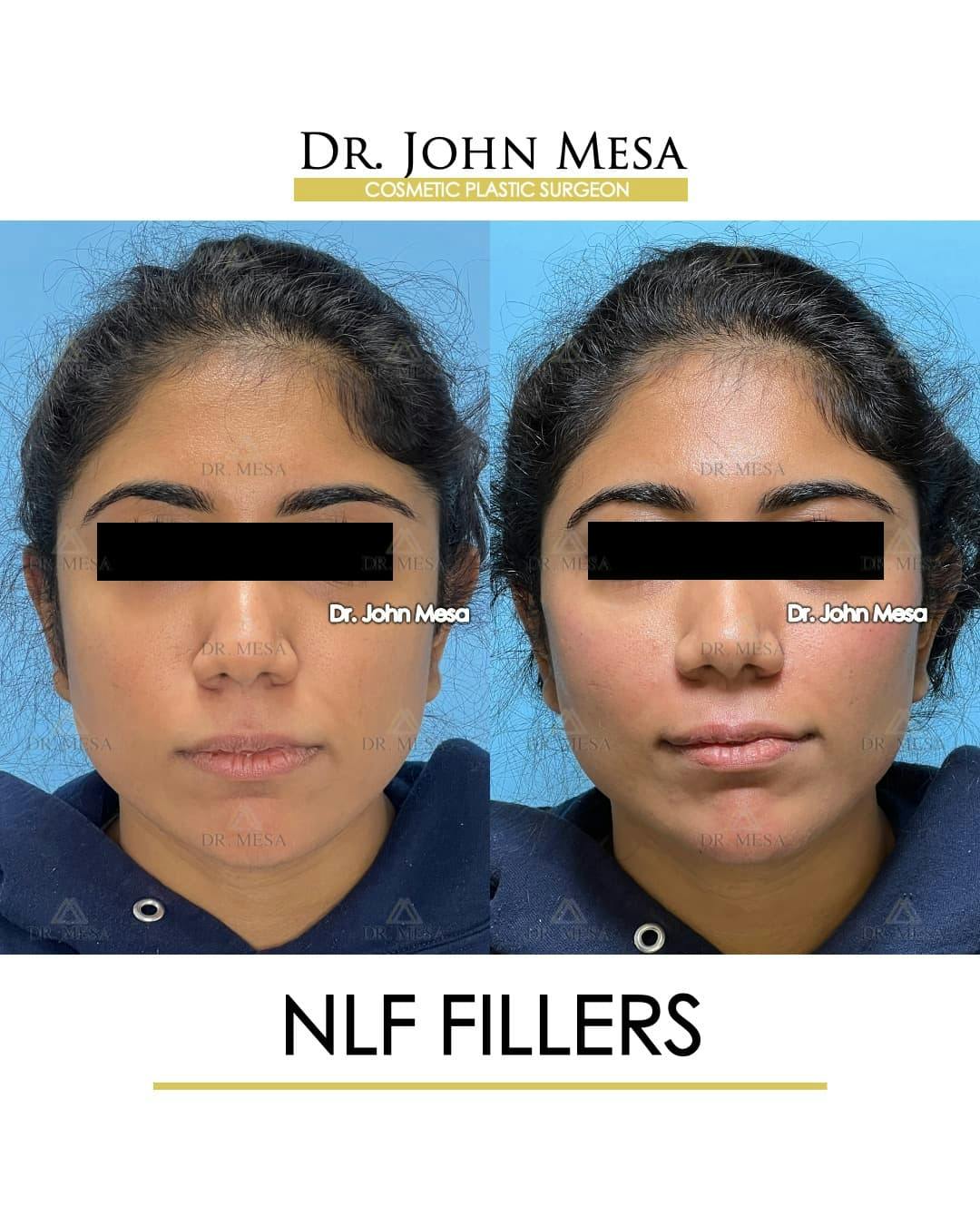 NLF Fillers Before & After Gallery - Patient 173309 - Image 1