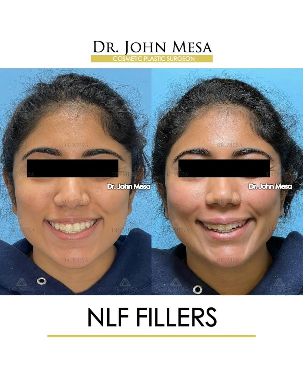 NLF Fillers Before & After Gallery - Patient 173309 - Image 2
