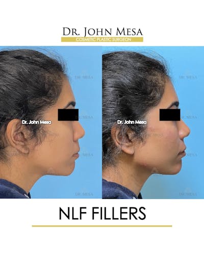 NLF Fillers Before & After Gallery - Patient 173309 - Image 4