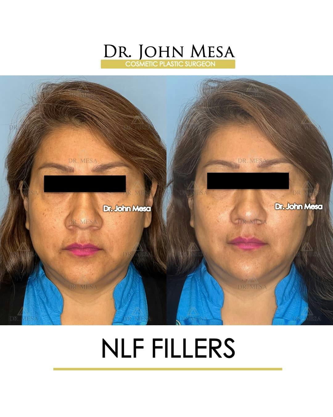 NLF Fillers Before & After Gallery - Patient 176995 - Image 1