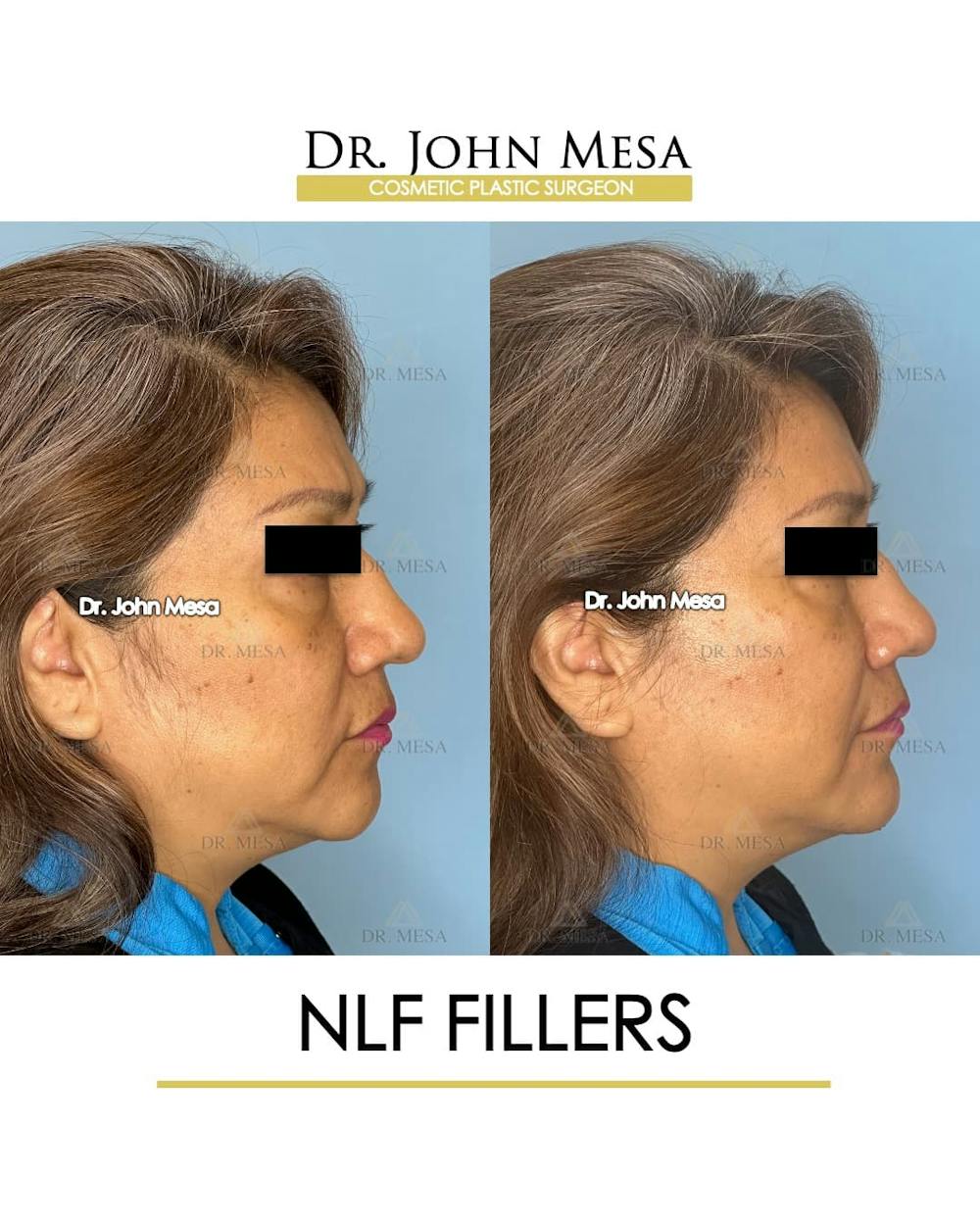 NLF Fillers Before & After Gallery - Patient 176995 - Image 3