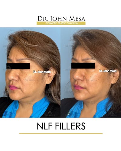 NLF Fillers Before & After Gallery - Patient 176995 - Image 4