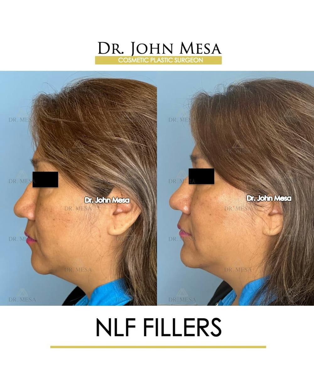 NLF Fillers Before & After Gallery - Patient 176995 - Image 5