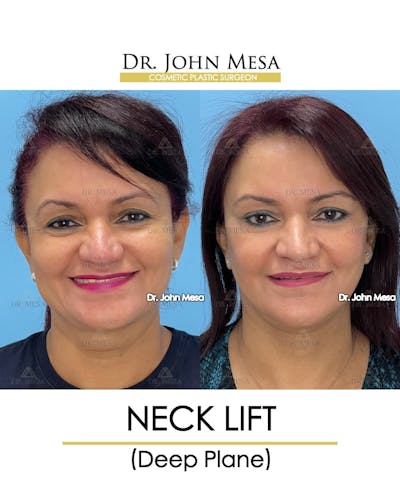 Neck Lift Before & After Gallery - Patient 255655 - Image 1
