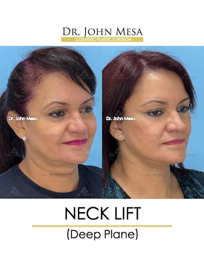 Neck Lift Before & After Gallery - Patient 255655 - Image 2