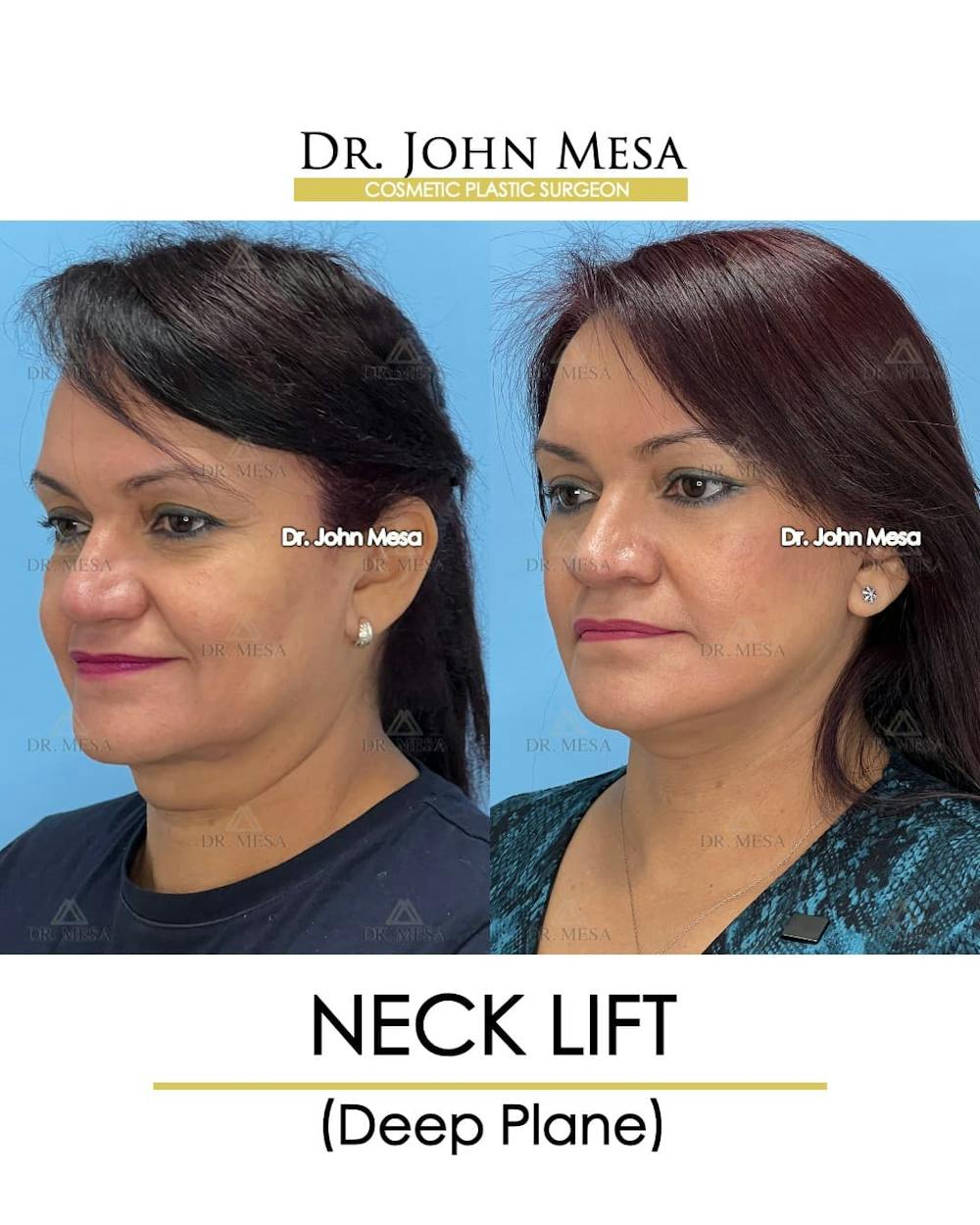 Neck Lift Before & After Gallery - Patient 255655 - Image 4