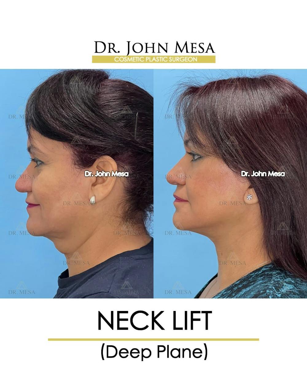 Neck Lift Before & After Gallery - Patient 255655 - Image 5
