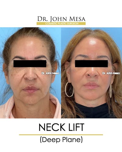 Neck Lift Before & After Gallery - Patient 326262 - Image 1