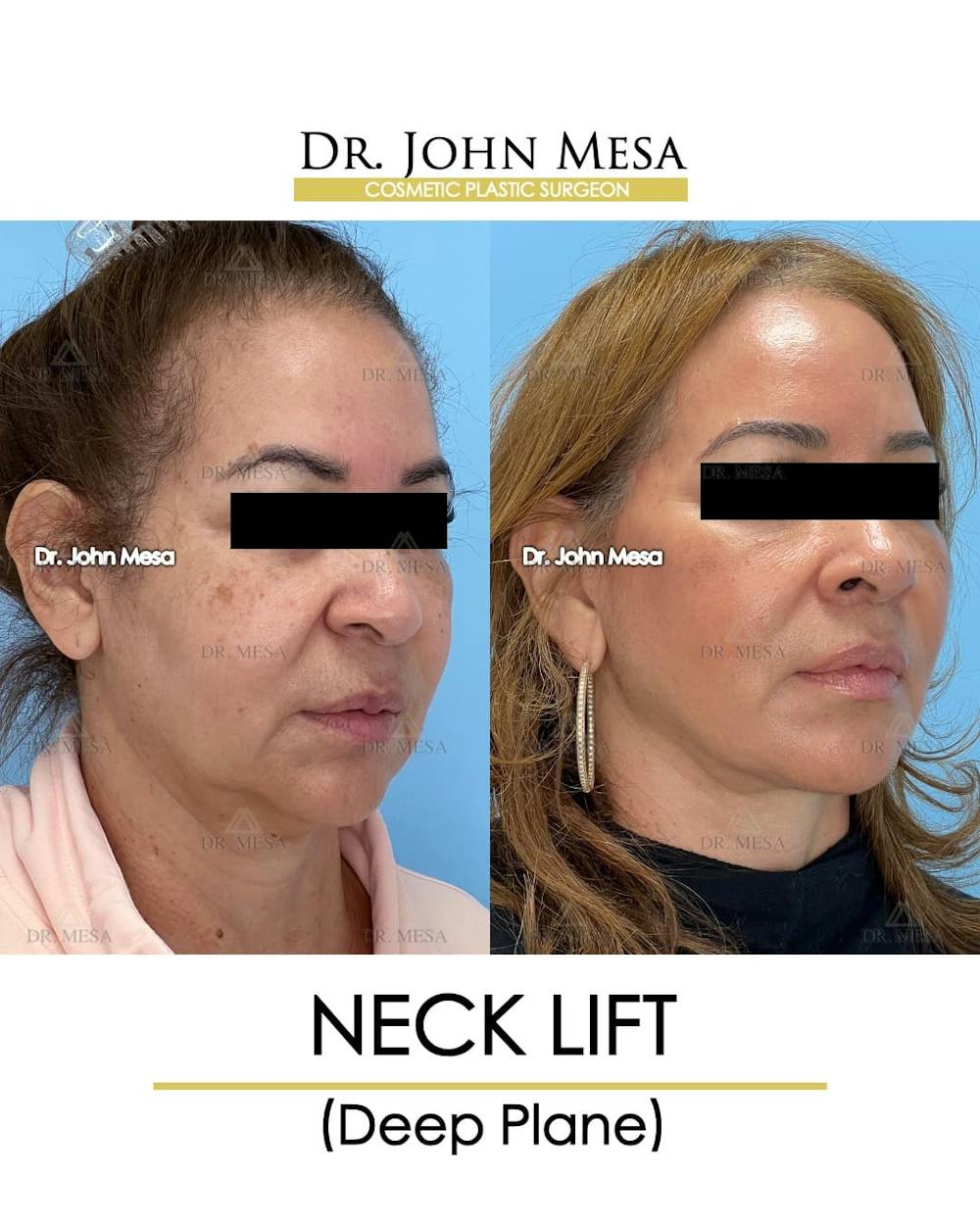 Neck Lift Before & After Gallery - Patient 326262 - Image 2