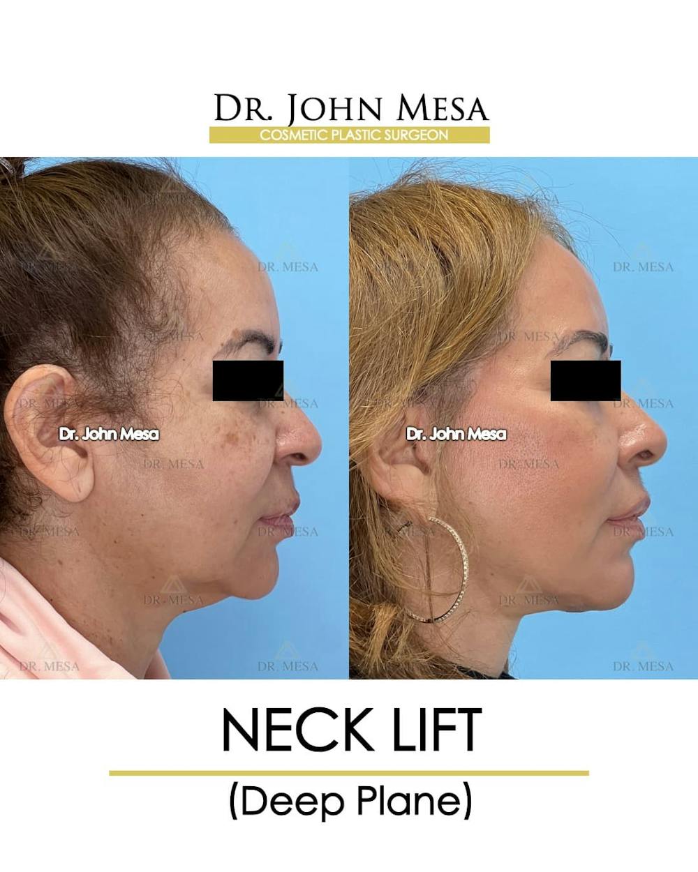 Neck Lift Before & After Gallery - Patient 326262 - Image 3