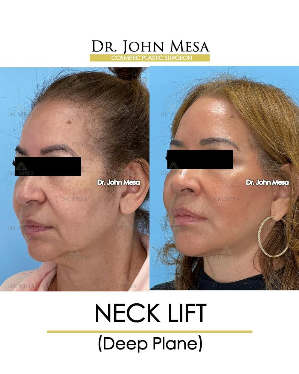 Neck Lift Before & After Gallery - Patient 326262 - Image 4
