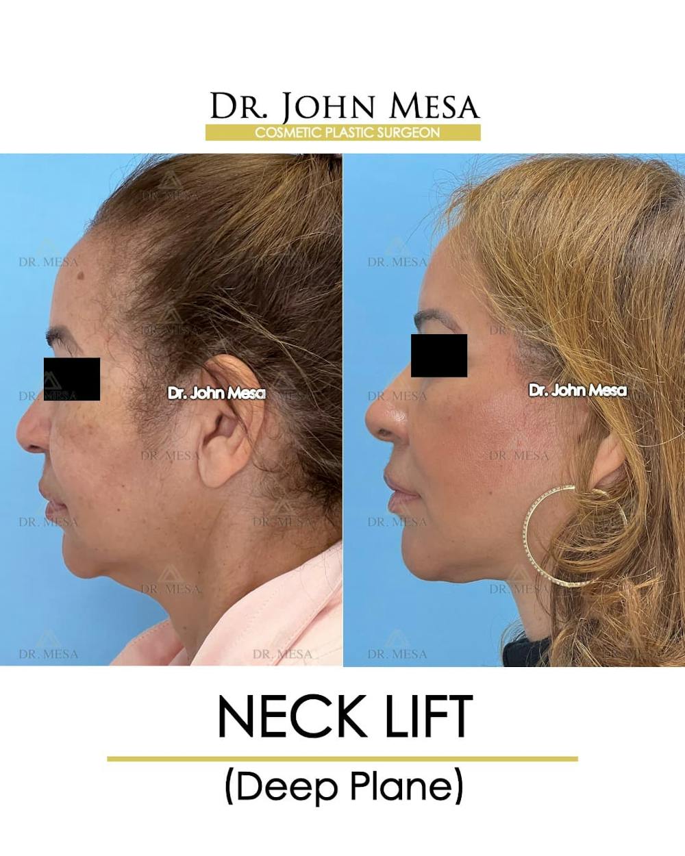 Neck Lift Before & After Gallery - Patient 326262 - Image 5
