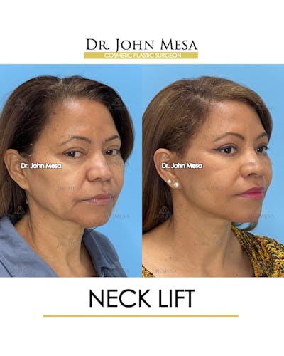 Neck Lift Before & After Gallery - Patient 165056 - Image 2
