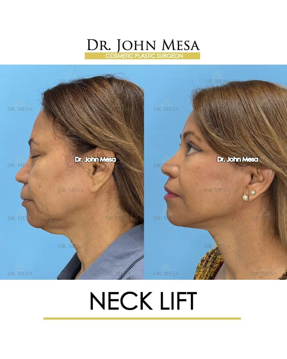 Neck Lift Before & After Gallery - Patient 165056 - Image 5
