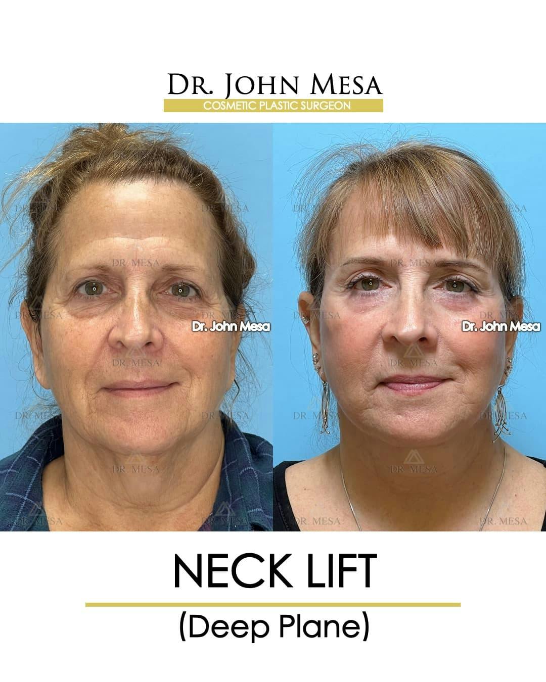 Neck Lift Before & After Gallery - Patient 134302 - Image 1