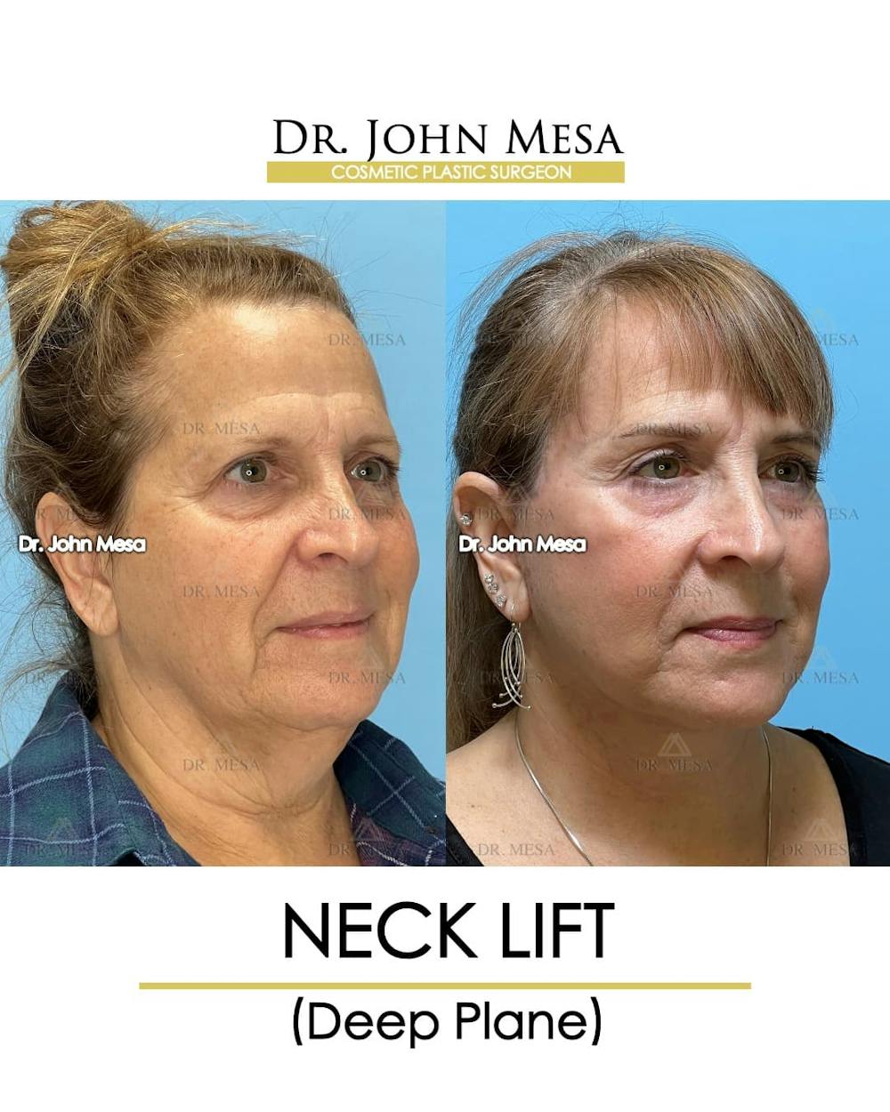 Neck Lift Before & After Gallery - Patient 134302 - Image 2
