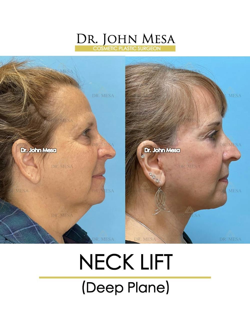 Neck Lift Before & After Gallery - Patient 134302 - Image 3