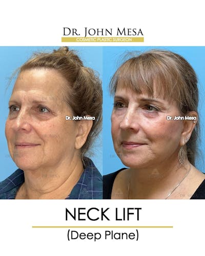 Neck Lift Before & After Gallery - Patient 134302 - Image 4
