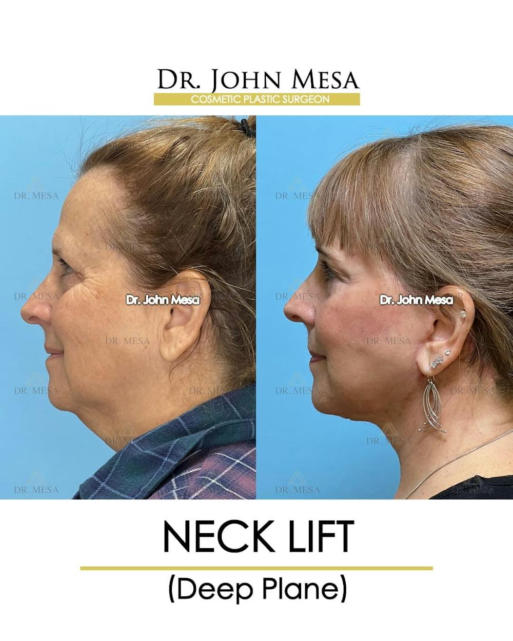 Neck Lift Before & After Gallery - Patient 134302 - Image 5