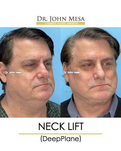 Neck Lift Before & After Gallery - Patient 313687 - Image 2