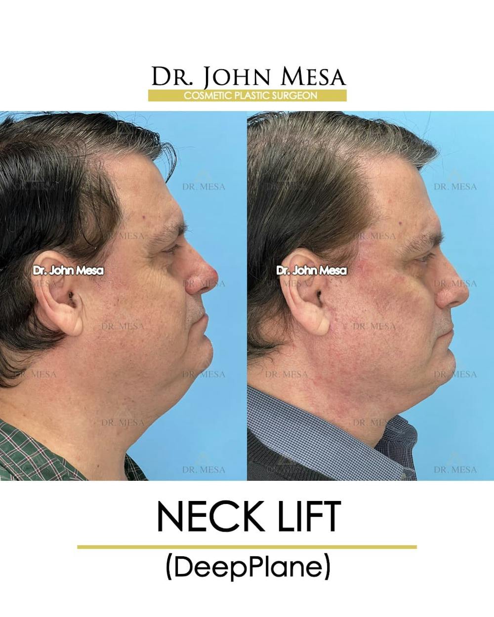 Neck Lift Before & After Gallery - Patient 313687 - Image 3