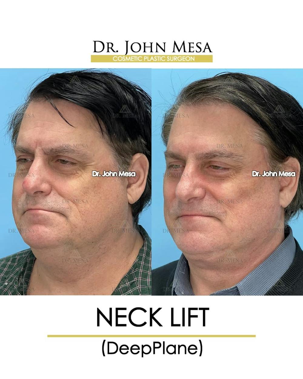 Neck Lift Before & After Gallery - Patient 313687 - Image 4