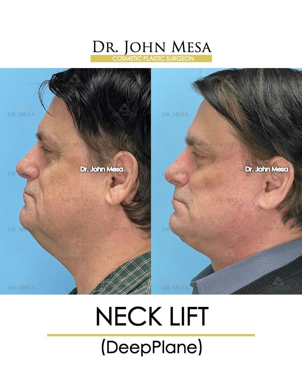 Neck Lift Before & After Gallery - Patient 313687 - Image 5