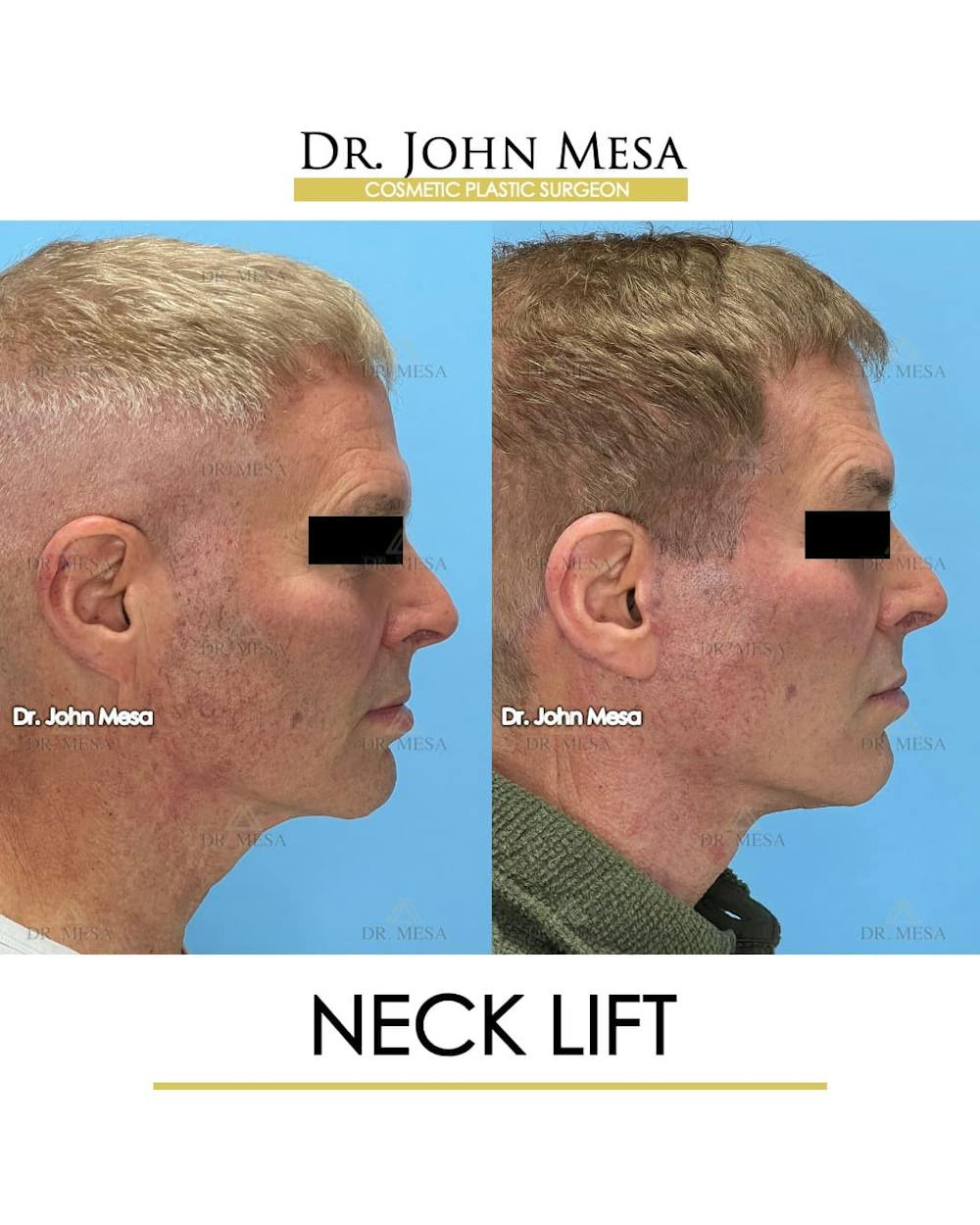 Neck Lift Before & After Gallery - Patient 428777 - Image 3