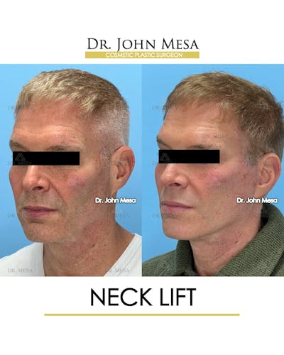 Neck Lift Before & After Gallery - Patient 428777 - Image 4