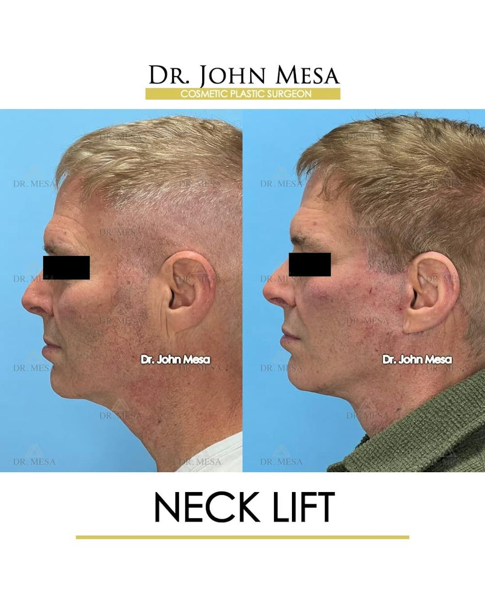 Neck Lift Before & After Gallery - Patient 428777 - Image 5