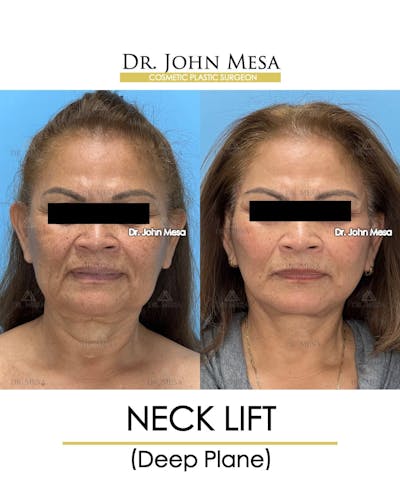 Neck Lift Before & After Gallery - Patient 182261 - Image 1
