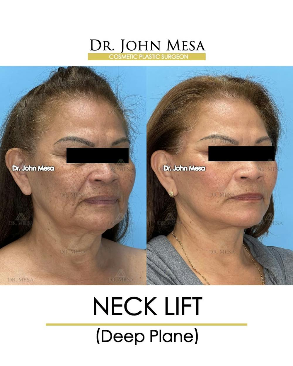 Neck Lift Before & After Gallery - Patient 182261 - Image 2