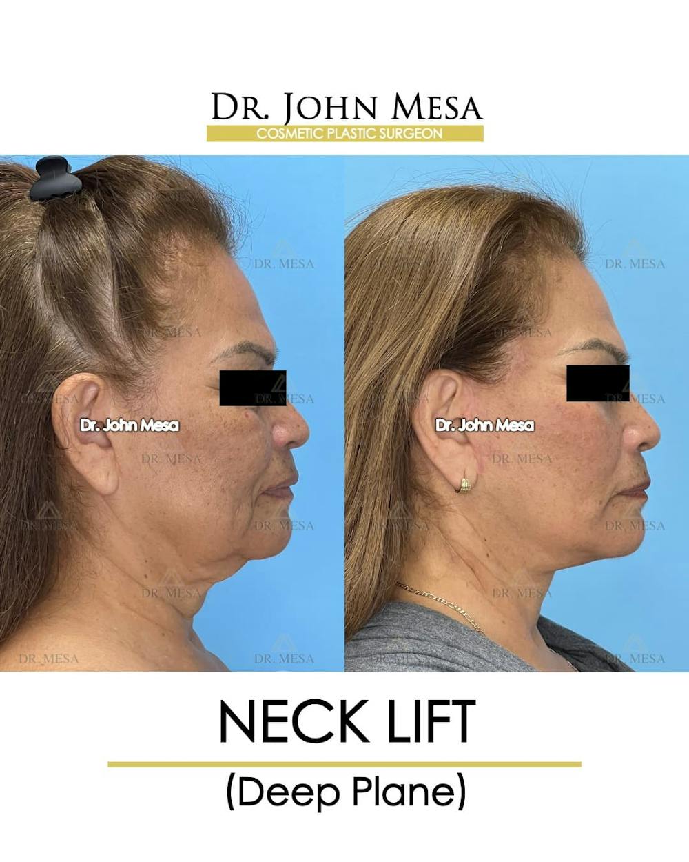 Neck Lift Before & After Gallery - Patient 182261 - Image 3