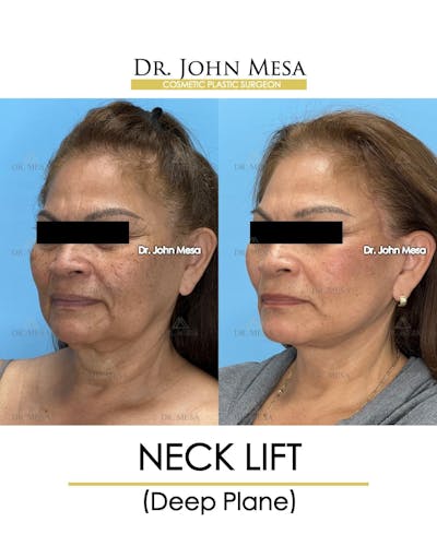 Neck Lift Before & After Gallery - Patient 182261 - Image 4