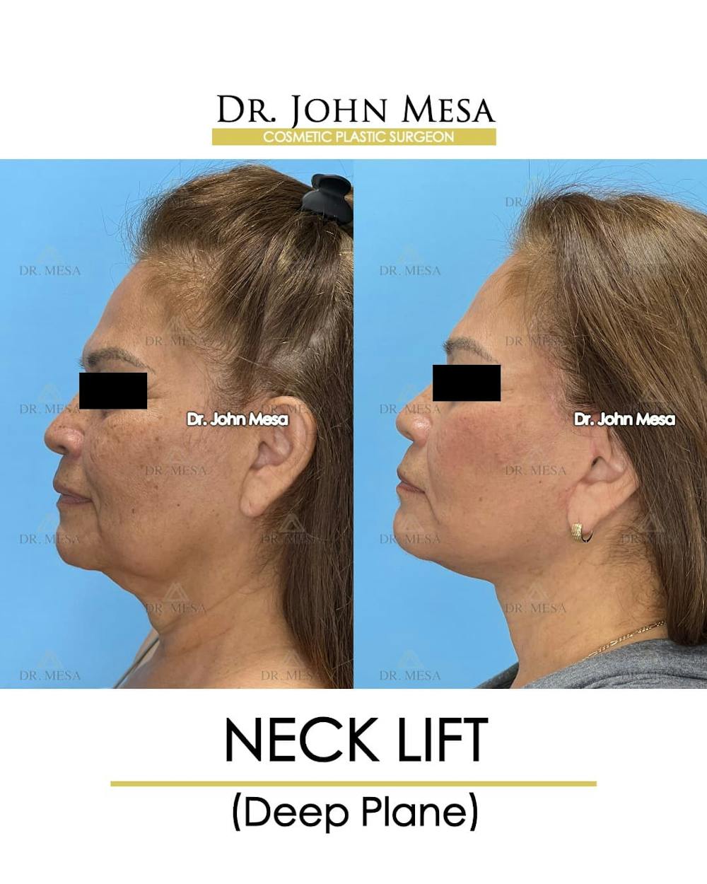 Neck Lift Before & After Gallery - Patient 182261 - Image 5