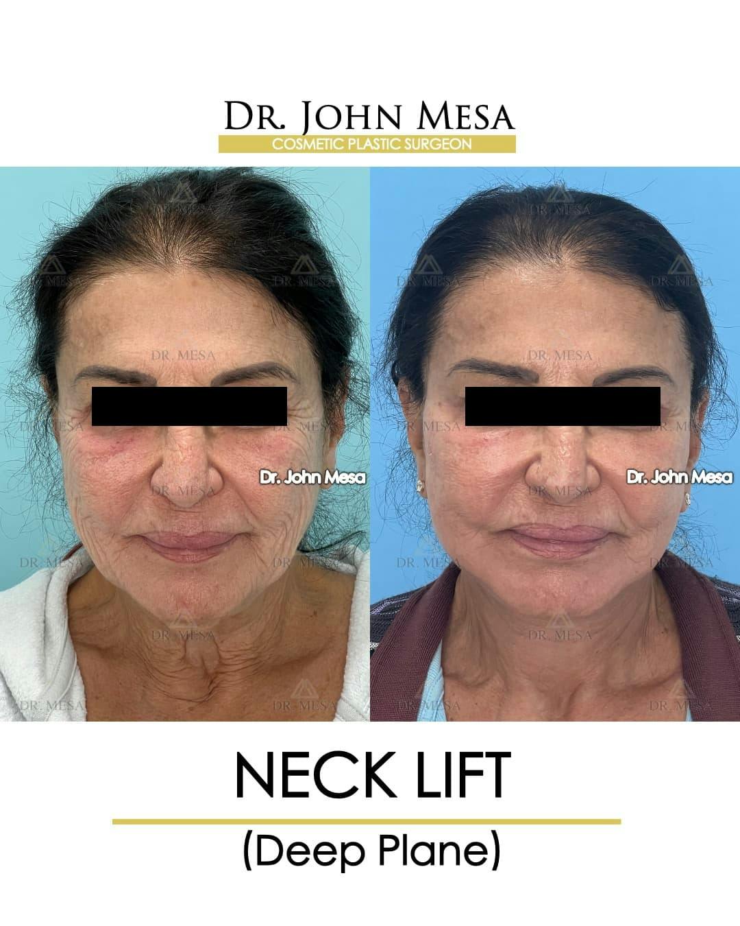 Neck Lift Before & After Gallery - Patient 217872 - Image 1