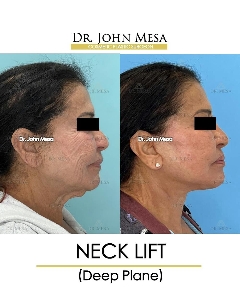 Neck Lift Before & After Gallery - Patient 217872 - Image 3