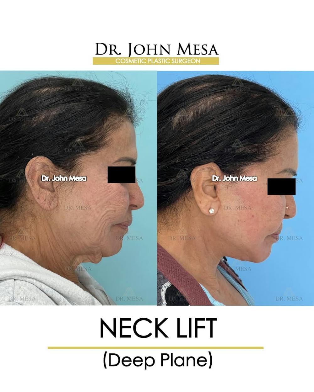 Neck Lift Before & After Gallery - Patient 217872 - Image 4