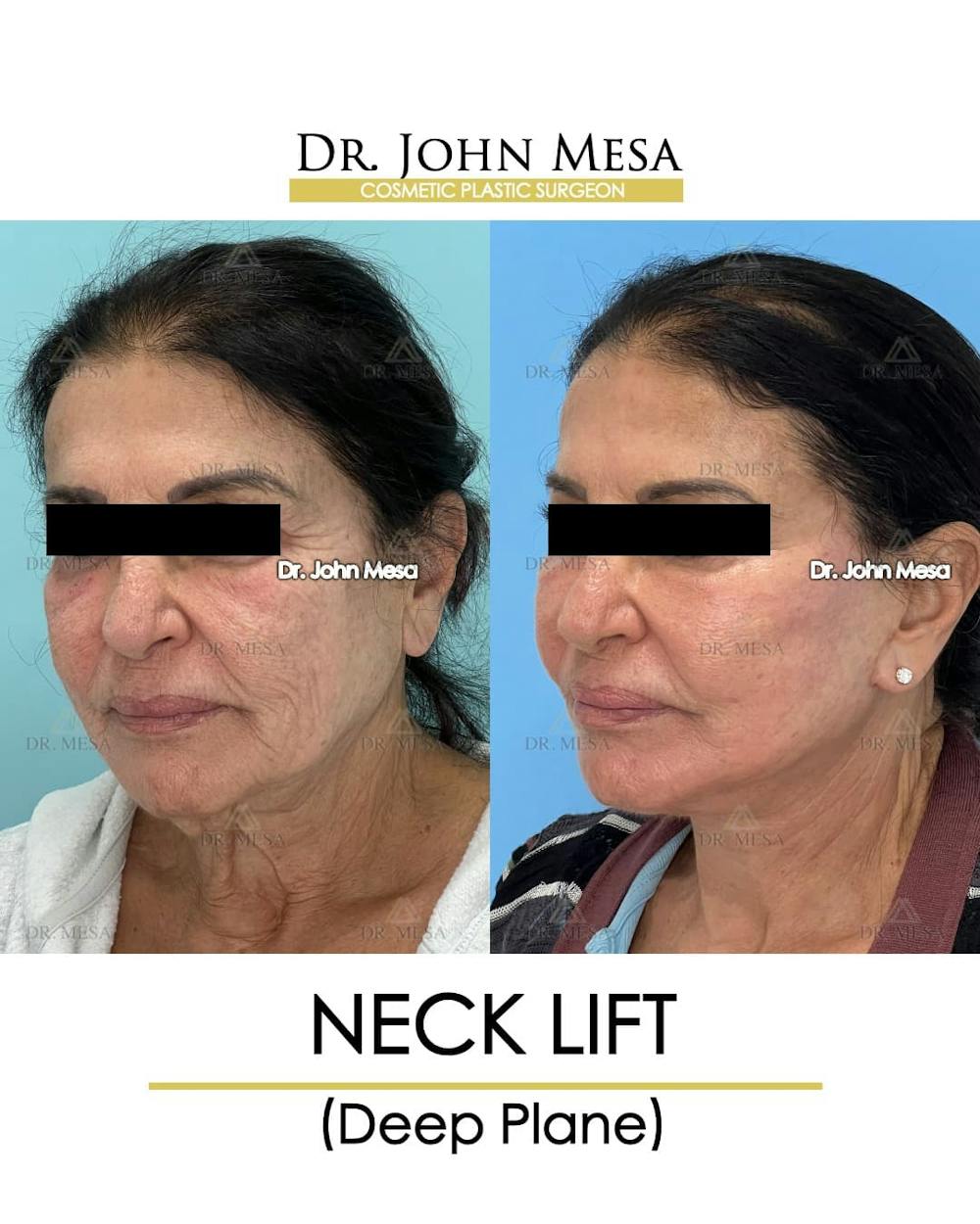Neck Lift Before & After Gallery - Patient 217872 - Image 5