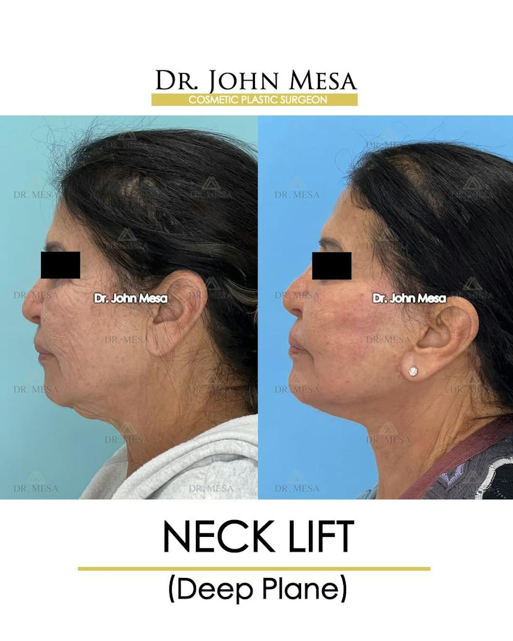 Neck Lift Before & After Gallery - Patient 217872 - Image 6