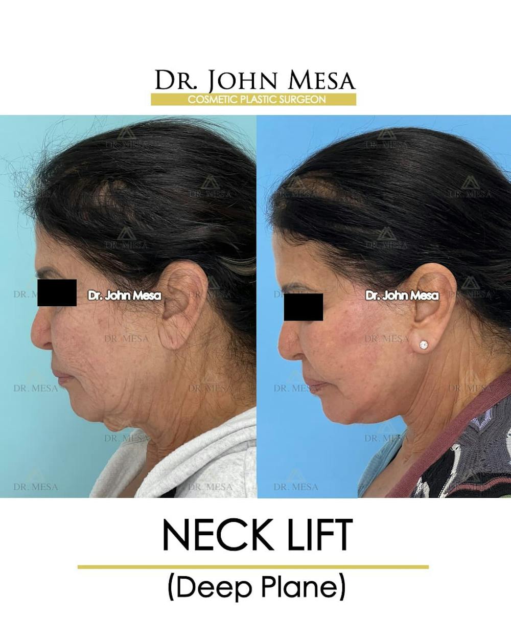 Neck Lift Before & After Gallery - Patient 217872 - Image 7