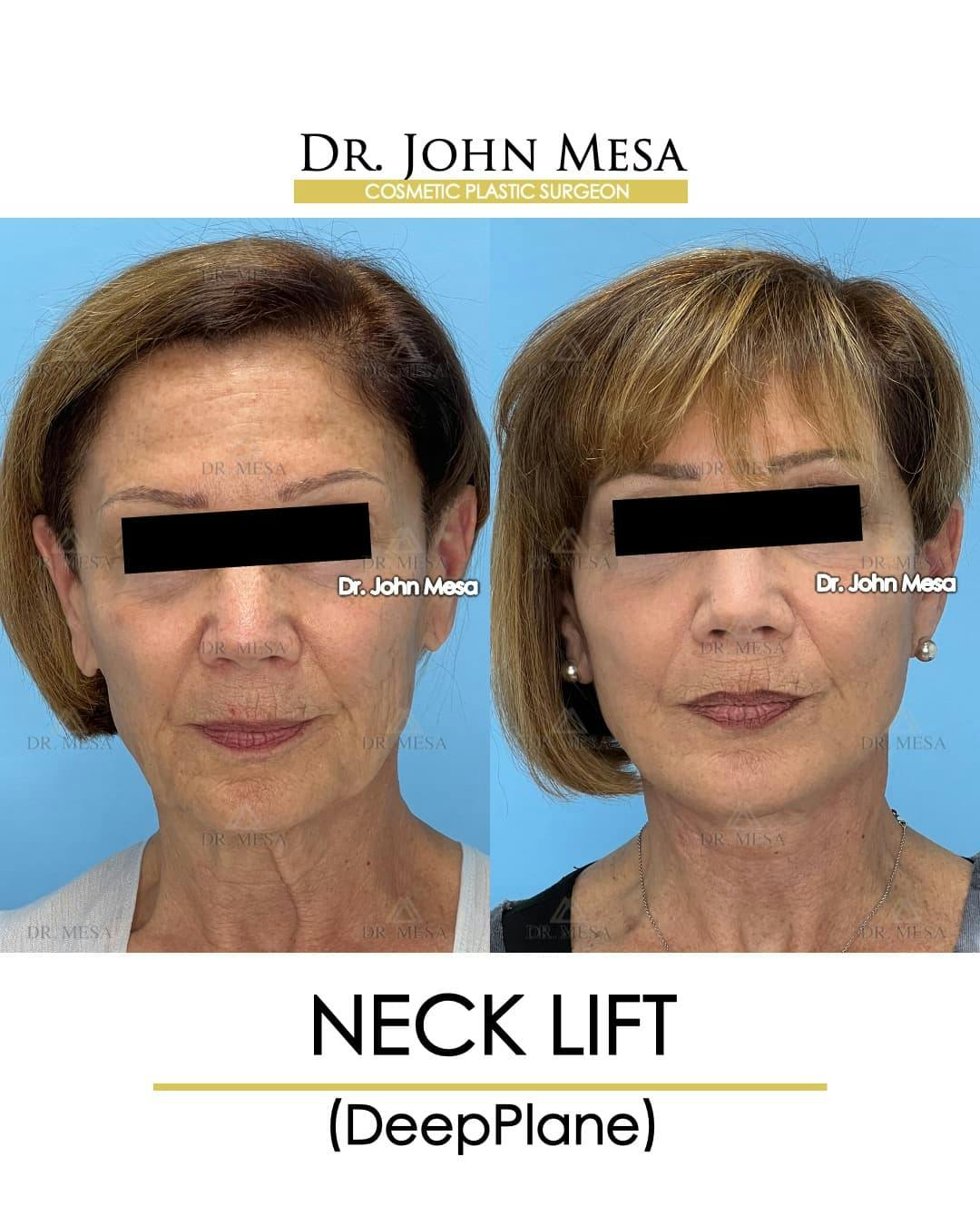 Neck Lift Before & After Gallery - Patient 176290 - Image 1