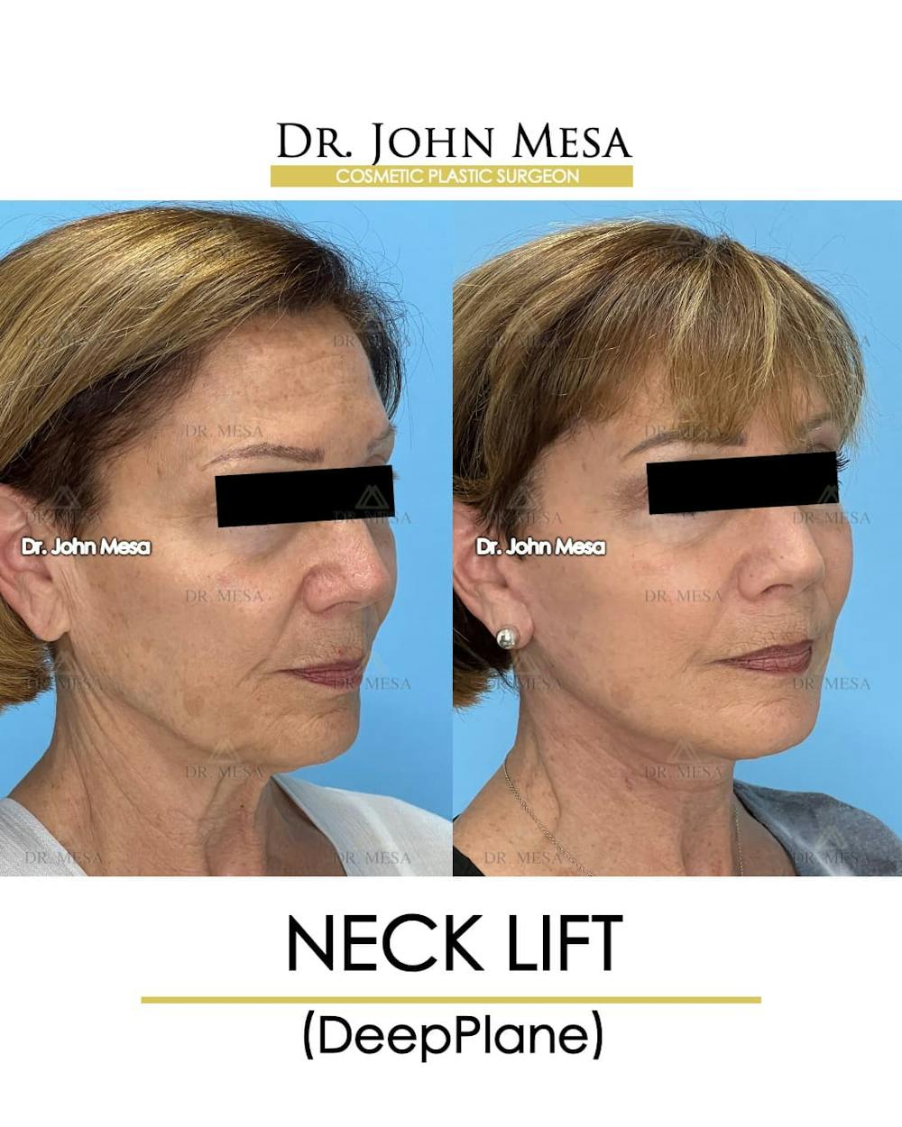 Neck Lift Before & After Gallery - Patient 176290 - Image 2