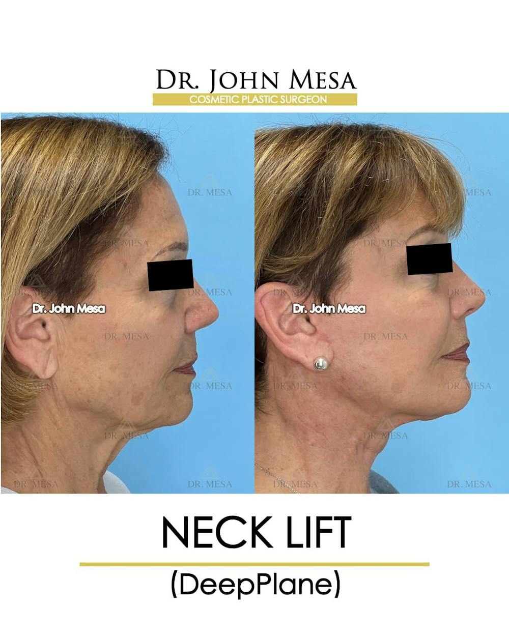 Neck Lift Before & After Gallery - Patient 176290 - Image 3
