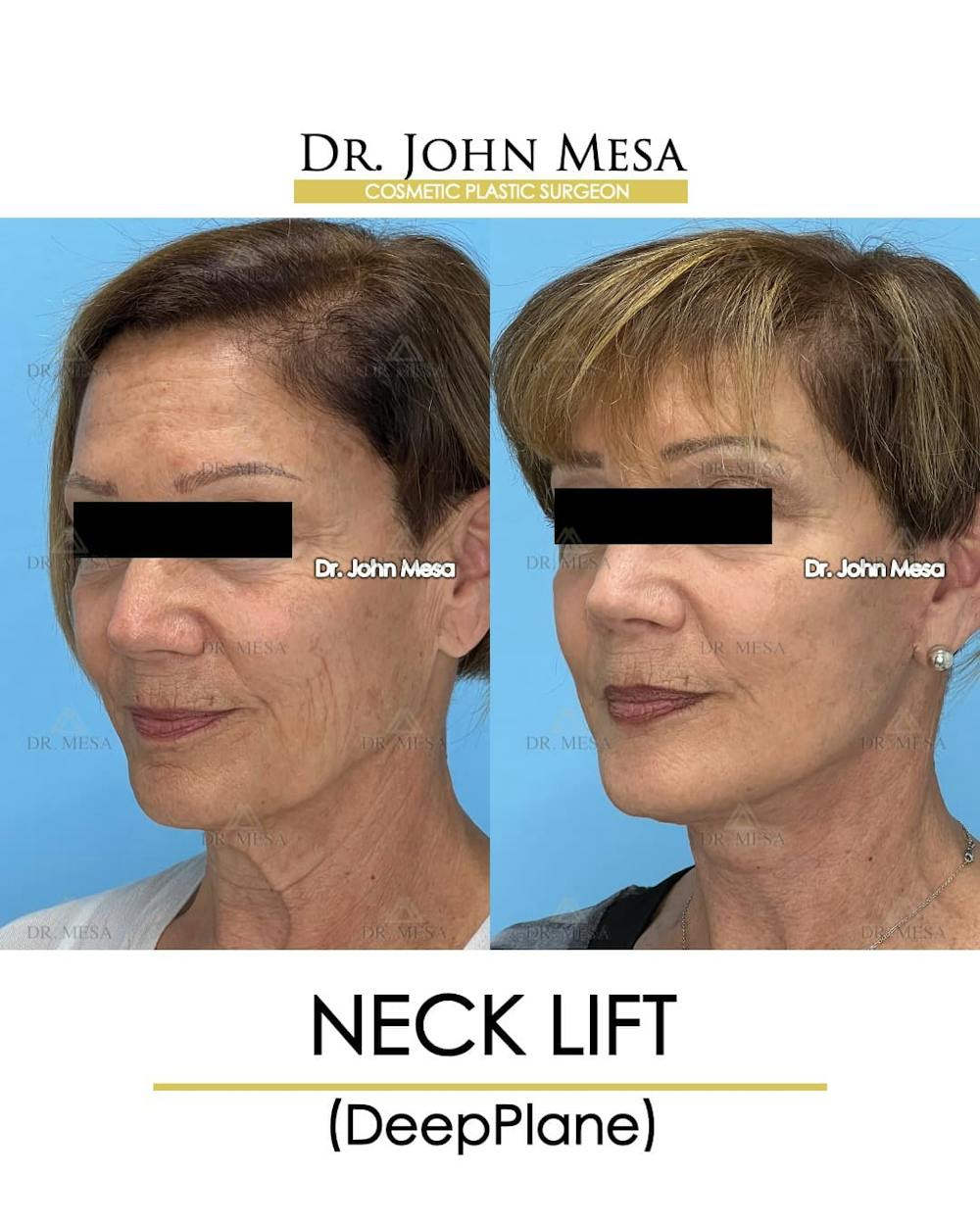 Neck Lift Before & After Gallery - Patient 176290 - Image 4