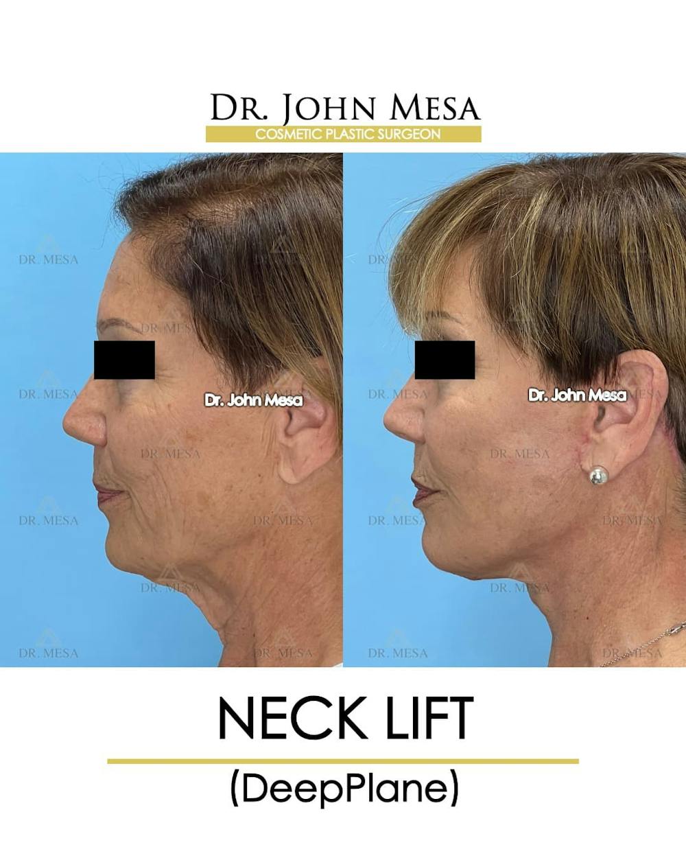 Neck Lift Before & After Gallery - Patient 176290 - Image 5